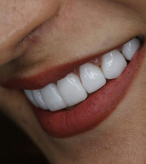 Are Veneers The Right Dental Treatment For You?