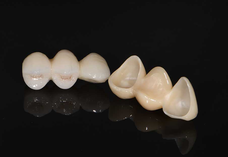  Dental Crowns & Fixed Bridge