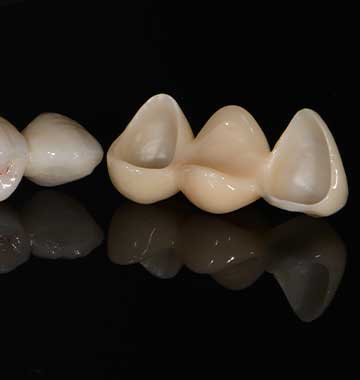 Dental Crowns and Fixed Bridges