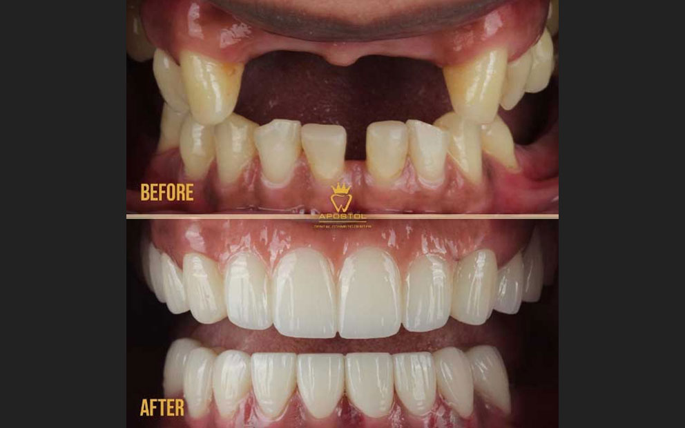 What Are Dental Bridges?