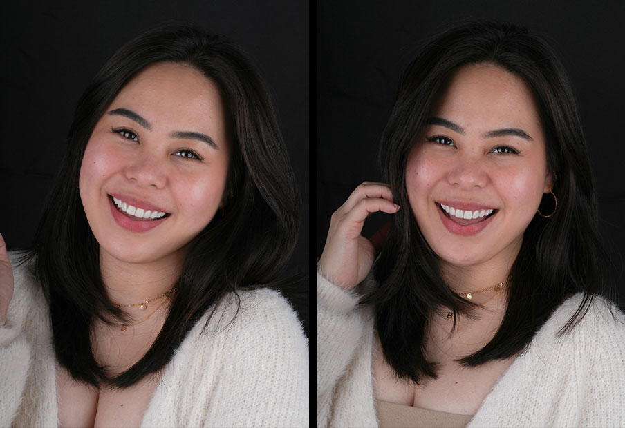 What Is a Dental Hollywood Smile?