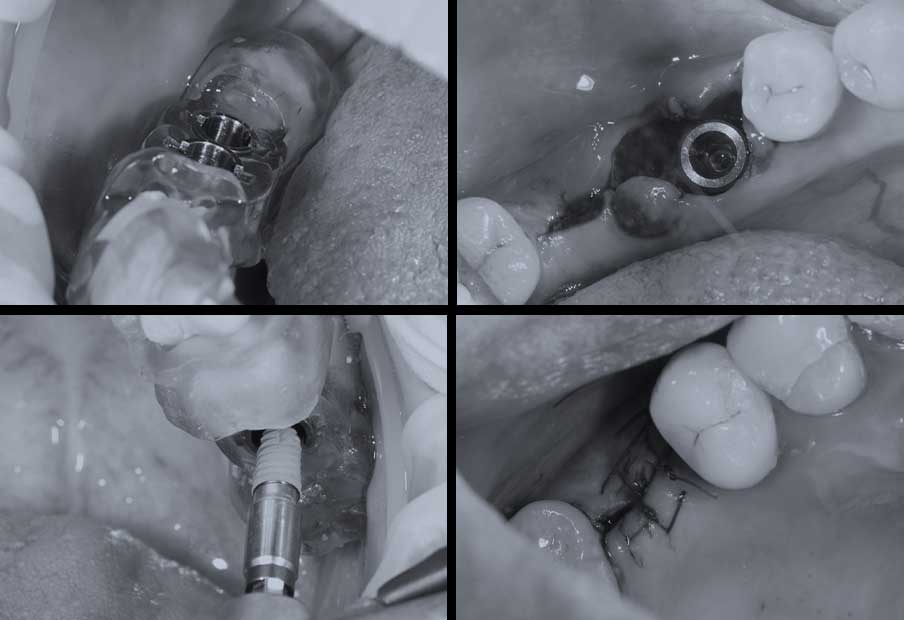 Dental Implants in the Philippines