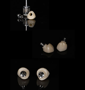 Dental Implants in the Philippines