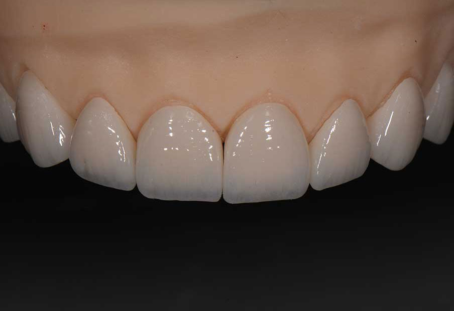 Dental Veneers