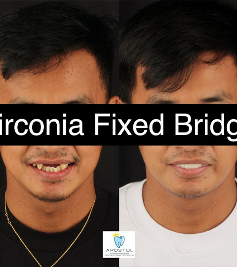 Helping People Solve their Insecurities through Getting an #Apostolified Fixed Bridge.