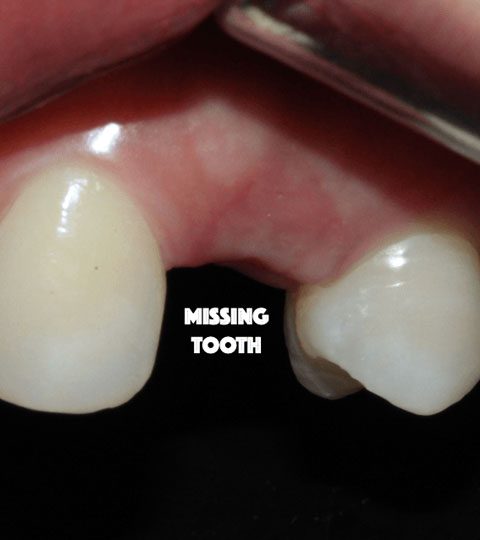 Missing Teeth? What’s The Best Option?