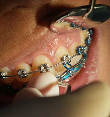 Orthodontics / Braces