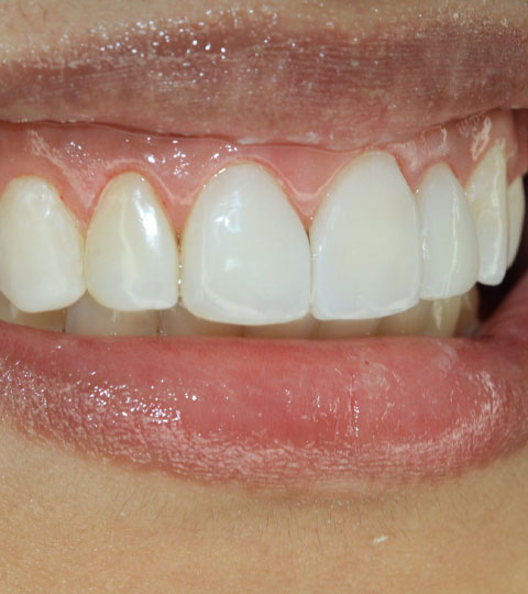 Renew Your Smile and Overall Dental Health