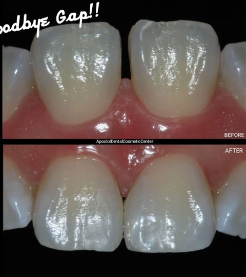 Say Goodbye To Teeth Gaps And Minor Cracks