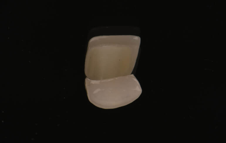 Porcelain Veneers