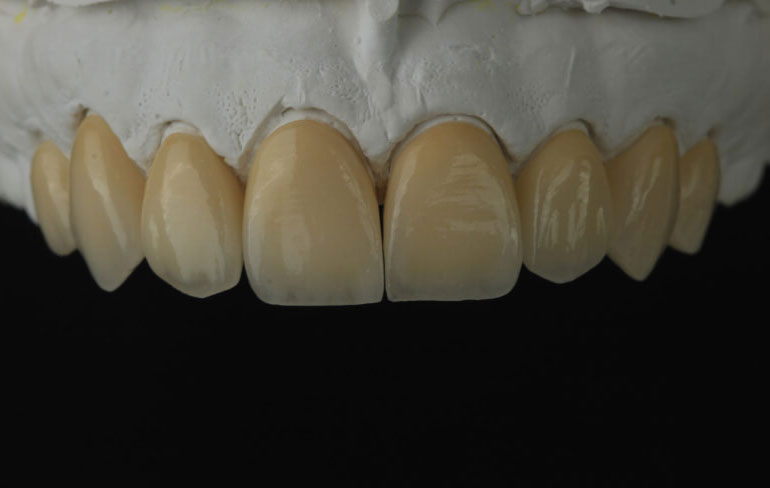 Zirconia Veneers