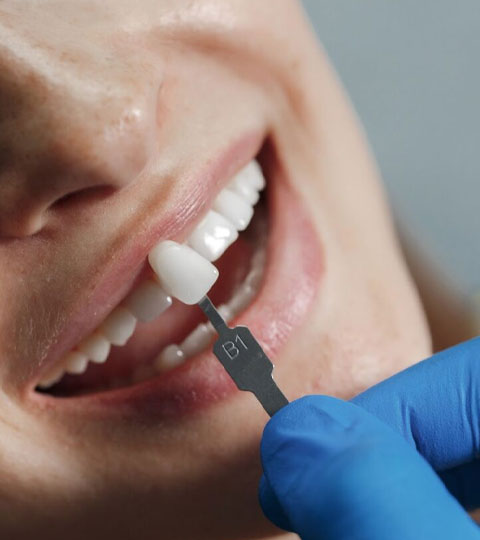 A Comprehensive Guide to Dental Crowns