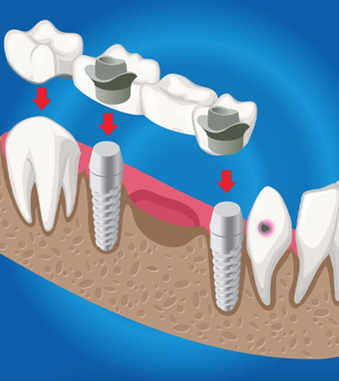 Overview of Dental Implants and Other Tooth Replacement Options
