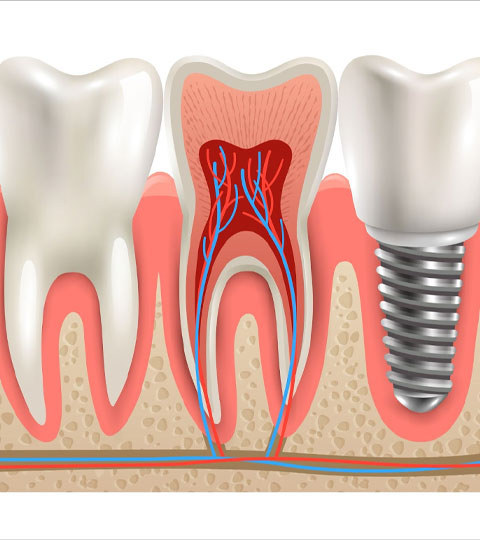 How to Choose Between Dental Implants and Bridges
