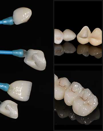 Dental Crowns & Bridges